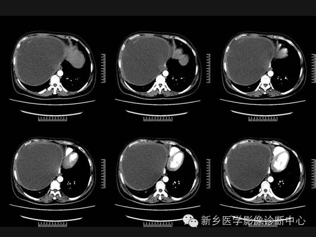 【病例】肝脏粘液性囊性肿瘤1例CT影像表现