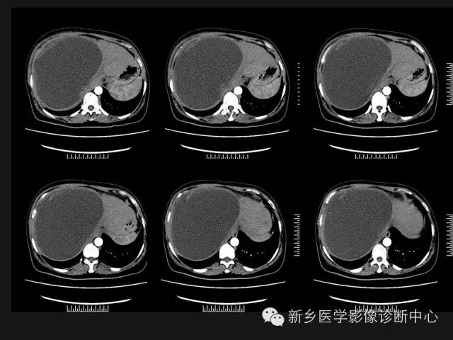 【病例】肝脏粘液性囊性肿瘤1例CT影像表现