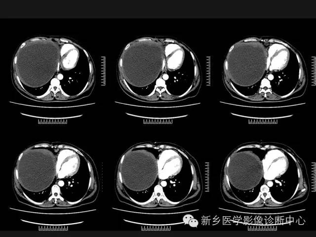 【病例】肝脏粘液性囊性肿瘤1例CT影像表现