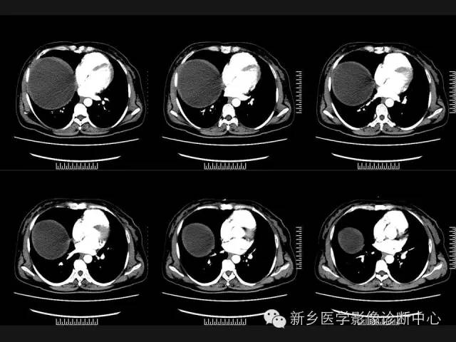 【病例】肝脏粘液性囊性肿瘤1例CT影像表现