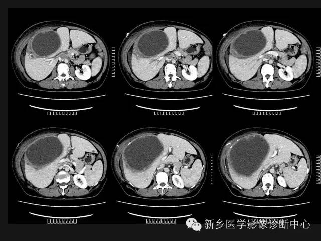 【病例】肝脏粘液性囊性肿瘤1例CT影像表现