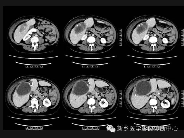 【病例】肝脏粘液性囊性肿瘤1例CT影像表现