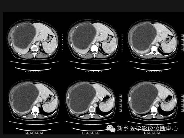 【病例】肝脏粘液性囊性肿瘤1例CT影像表现