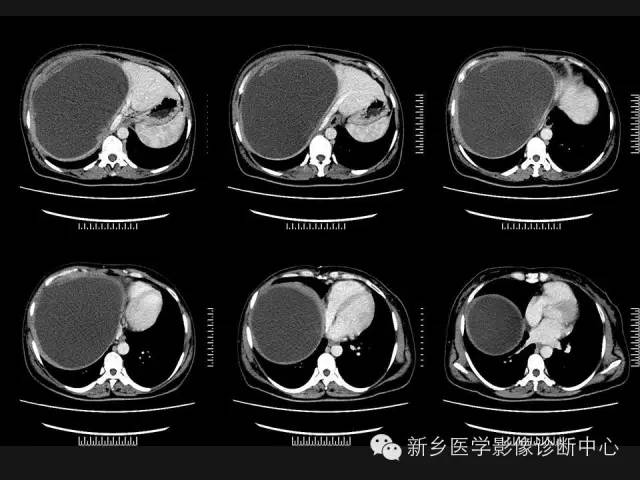 【病例】肝脏粘液性囊性肿瘤1例CT影像表现