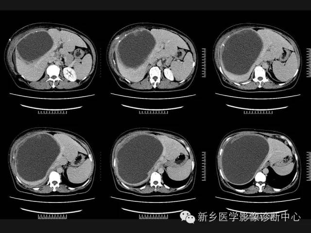 【病例】肝脏粘液性囊性肿瘤1例CT影像表现