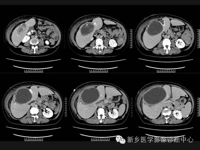 【病例】肝脏粘液性囊性肿瘤1例CT影像表现