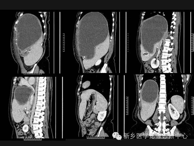 【病例】肝脏粘液性囊性肿瘤1例CT影像表现