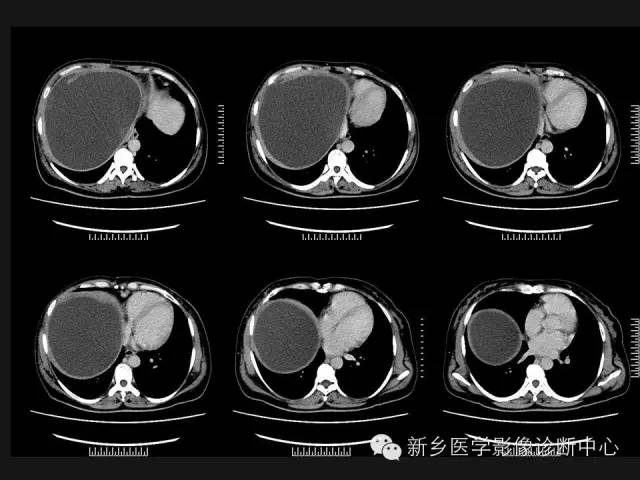【病例】肝脏粘液性囊性肿瘤1例CT影像表现