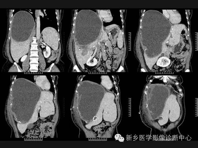 【病例】肝脏粘液性囊性肿瘤1例CT影像表现