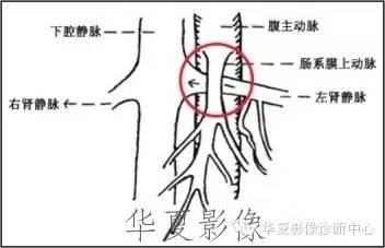 胡桃夹综合征