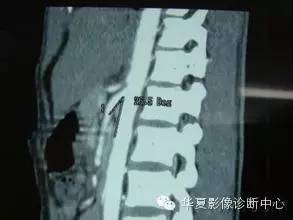 胡桃夹综合征