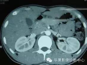 胡桃夹综合征 胡桃夹综合征