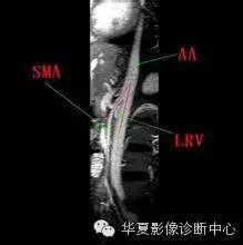 胡桃夹综合征 胡桃夹综合征