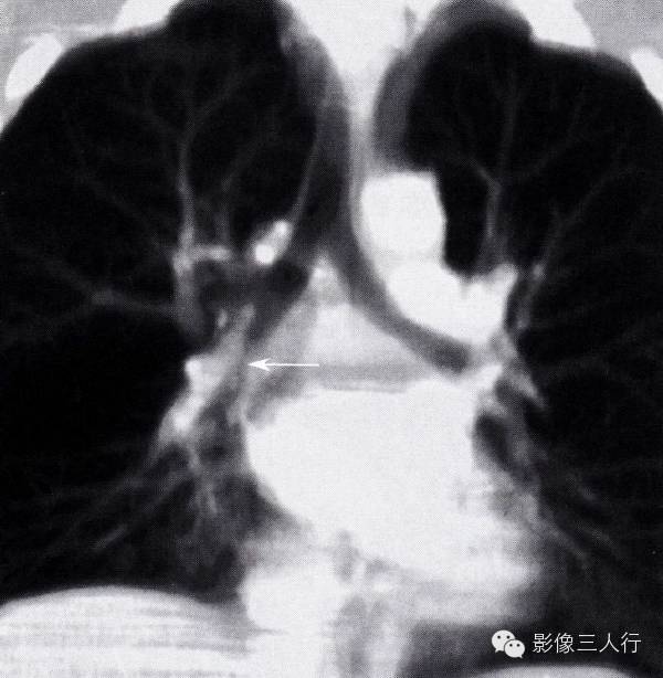 支气管异物的那些间接征象