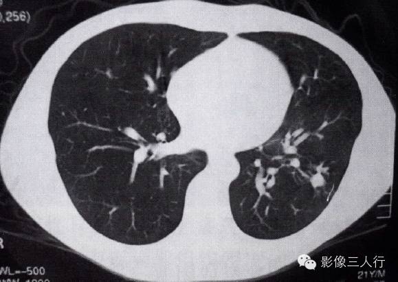 支气管异物的那些间接征象