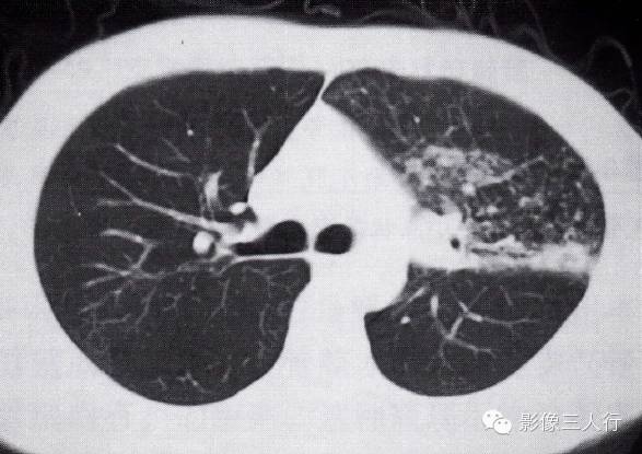 支气管异物的那些间接征象