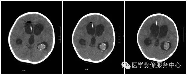 【病例】侧脑室脉络丛乳头状瘤1例CT MR影像表现