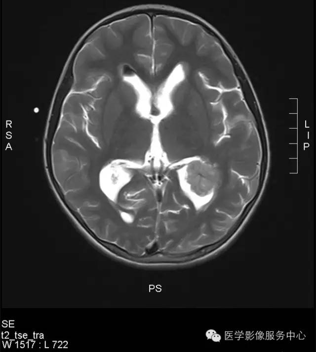 【病例】侧脑室脉络丛乳头状瘤1例CT MR影像表现 【病例】侧脑室脉络丛乳头状瘤1例CT MR影像表现