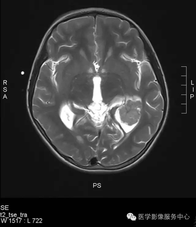 【病例】侧脑室脉络丛乳头状瘤1例CT MR影像表现 【病例】侧脑室脉络丛乳头状瘤1例CT MR影像表现