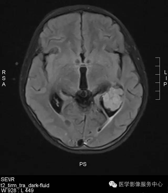 【病例】侧脑室脉络丛乳头状瘤1例CT MR影像表现 【病例】侧脑室脉络丛乳头状瘤1例CT MR影像表现