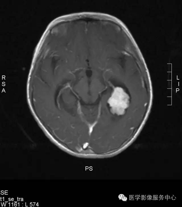 【病例】侧脑室脉络丛乳头状瘤1例CT MR影像表现 【病例】侧脑室脉络丛乳头状瘤1例CT MR影像表现