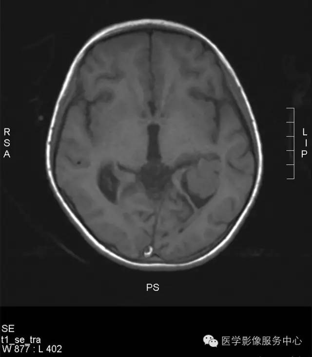 【病例】侧脑室脉络丛乳头状瘤1例CT MR影像表现 【病例】侧脑室脉络丛乳头状瘤1例CT MR影像表现