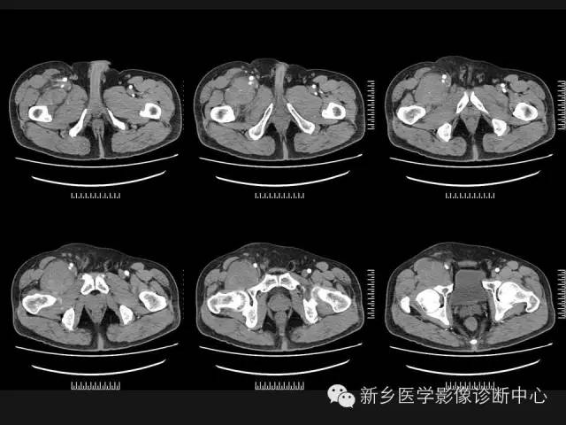 【病例】外周性PNET一例CT影像表现