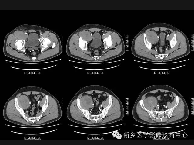 【病例】外周性PNET一例CT影像表现