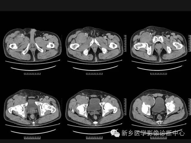 【病例】外周性PNET一例CT影像表现
