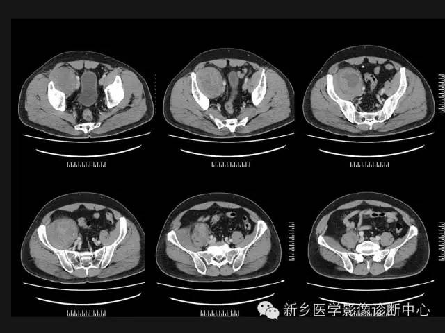 【病例】外周性PNET一例CT影像表现