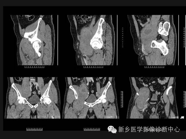 【病例】外周性PNET一例CT影像表现
