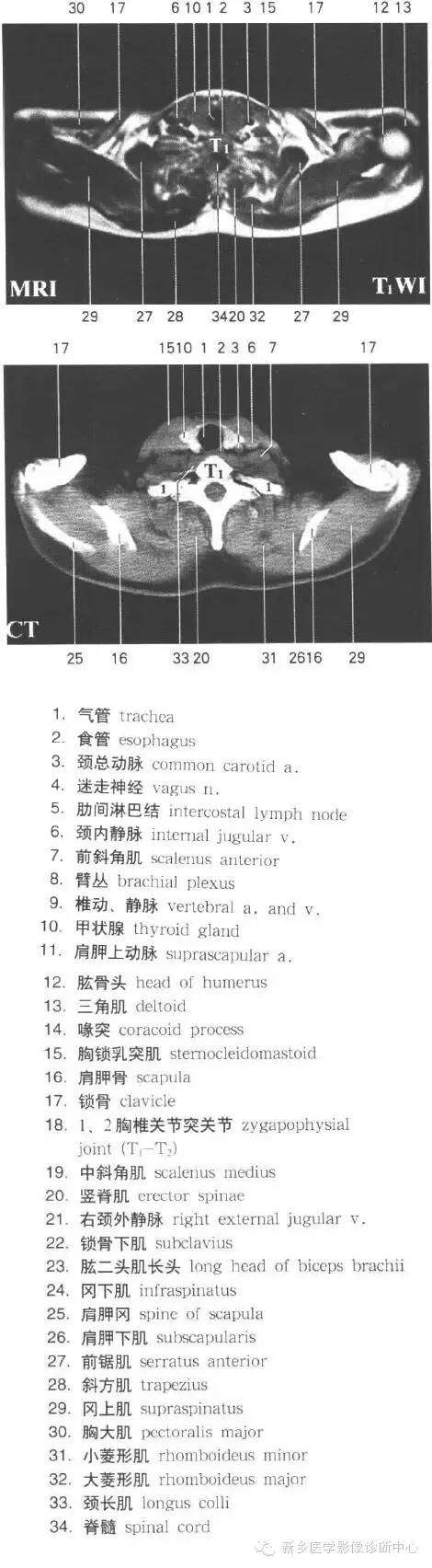 胸部横断位解剖+详细标注