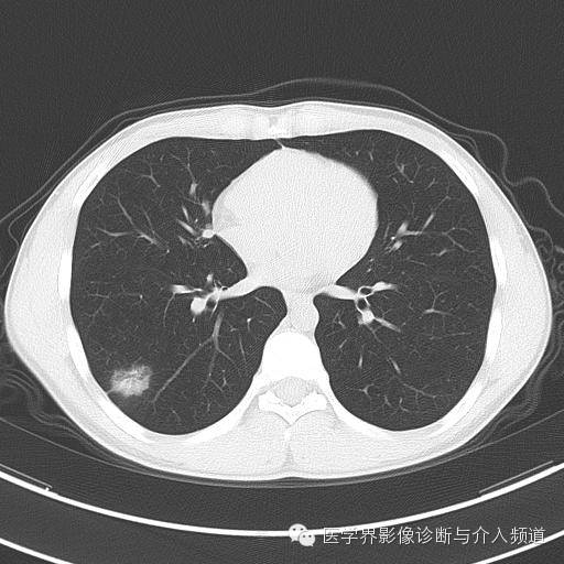 【病例】肺隐球菌病1例CT影像表现