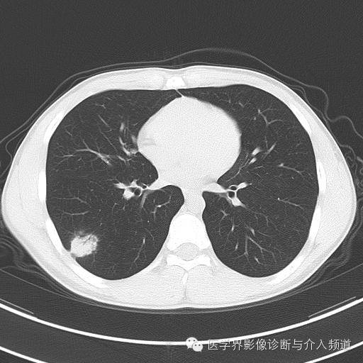 【病例】肺隐球菌病1例CT影像表现 【病例】肺隐球菌病1例CT影像表现