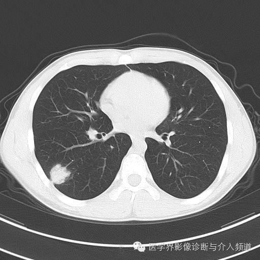 【病例】肺隐球菌病1例CT影像表现 【病例】肺隐球菌病1例CT影像表现