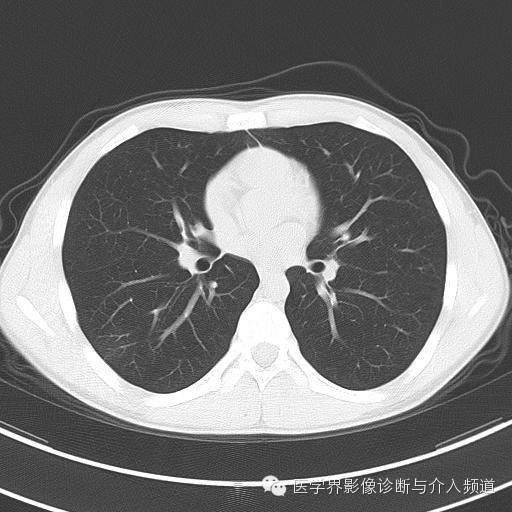 【病例】肺隐球菌病1例CT影像表现 【病例】肺隐球菌病1例CT影像表现