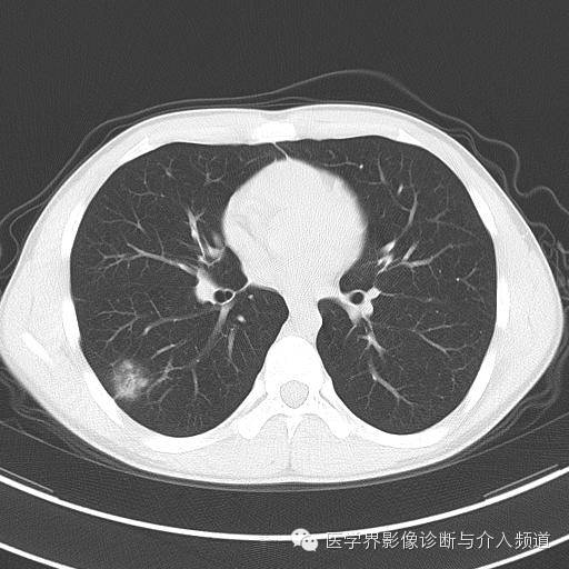 【病例】肺隐球菌病1例CT影像表现 【病例】肺隐球菌病1例CT影像表现