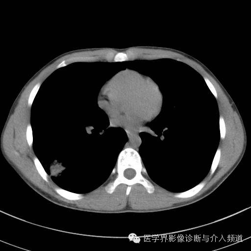 【病例】肺隐球菌病1例CT影像表现 【病例】肺隐球菌病1例CT影像表现