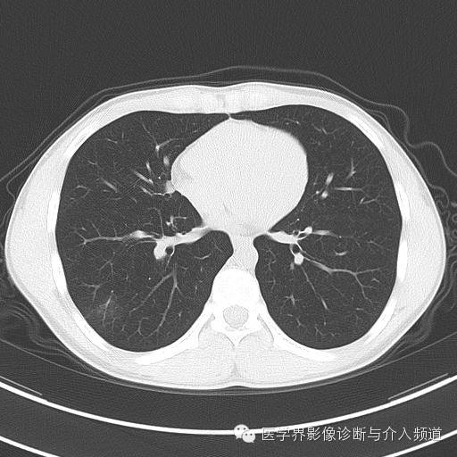 【病例】肺隐球菌病1例CT影像表现 【病例】肺隐球菌病1例CT影像表现