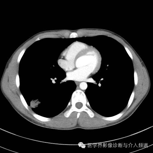 【病例】肺隐球菌病1例CT影像表现 【病例】肺隐球菌病1例CT影像表现