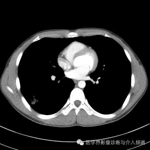 【病例】肺隐球菌病1例CT影像表现 【病例】肺隐球菌病1例CT影像表现