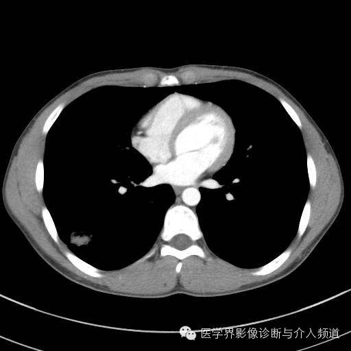 【病例】肺隐球菌病1例CT影像表现 【病例】肺隐球菌病1例CT影像表现
