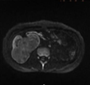 【病例】肾复杂性囊肿1例MR影像表现 【病例】肾复杂性囊肿1例MR影像表现