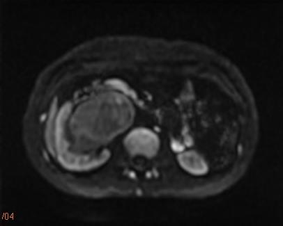 【病例】肾复杂性囊肿1例MR影像表现 【病例】肾复杂性囊肿1例MR影像表现