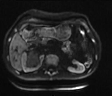 【病例】肾复杂性囊肿1例MR影像表现 【病例】肾复杂性囊肿1例MR影像表现