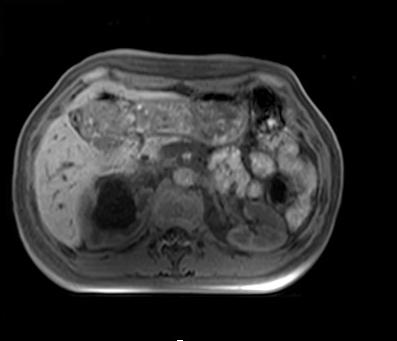 【病例】肾复杂性囊肿1例MR影像表现 【病例】肾复杂性囊肿1例MR影像表现