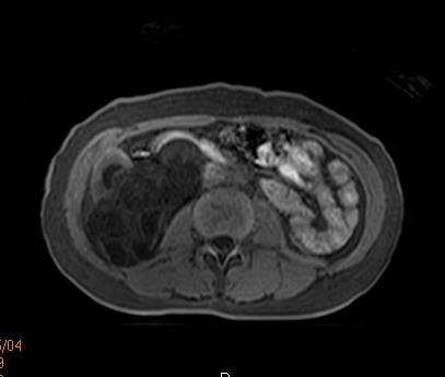【病例】肾复杂性囊肿1例MR影像表现 【病例】肾复杂性囊肿1例MR影像表现