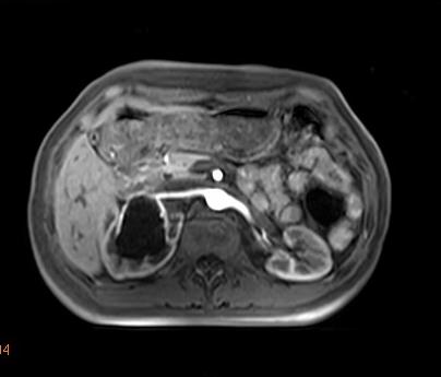 【病例】肾复杂性囊肿1例MR影像表现 【病例】肾复杂性囊肿1例MR影像表现