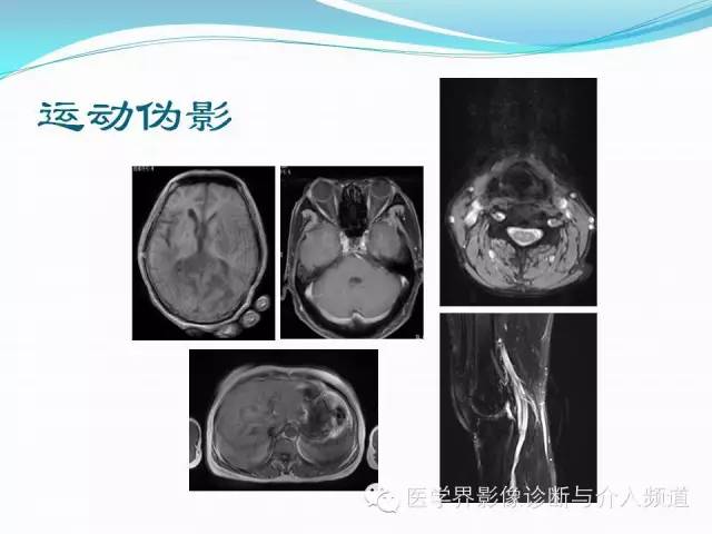 【PPT】磁共振常见伪影及对策