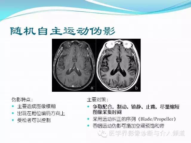 【PPT】磁共振常见伪影及对策